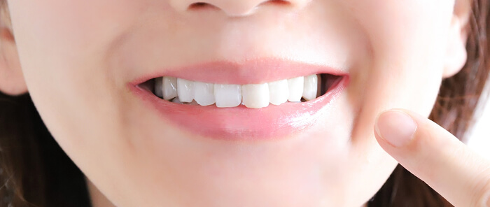 ホワイトニング